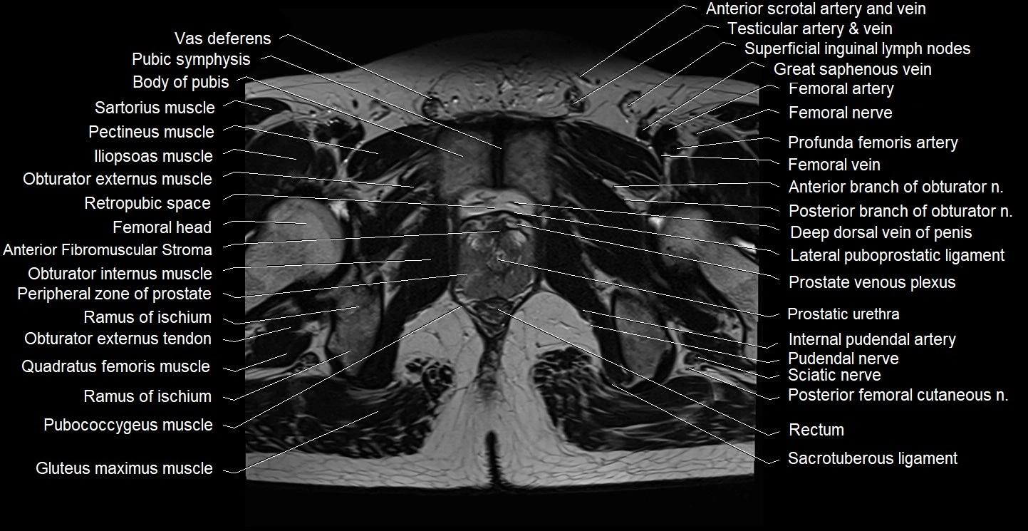Male pelvis axial cross sectional anatomy image 35.webp